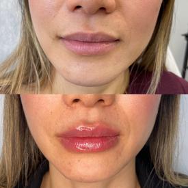 Fascination About Skin Tightening, Botox And Lip Fillers By Skinsation La thumbnail